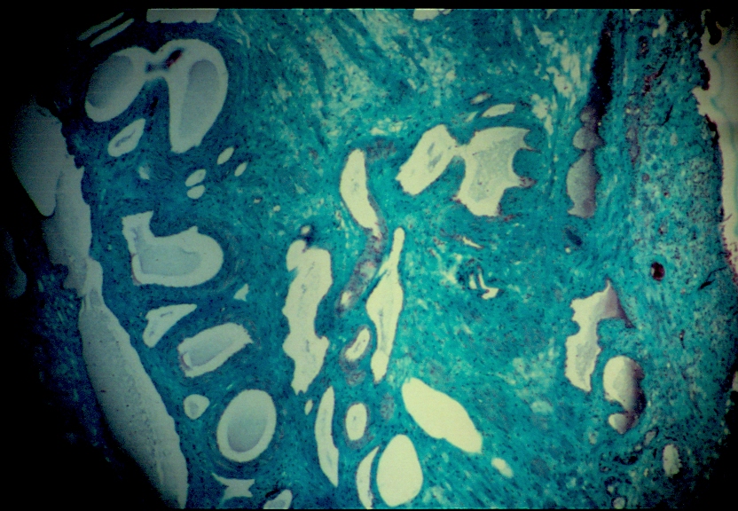 sclérose histologie.